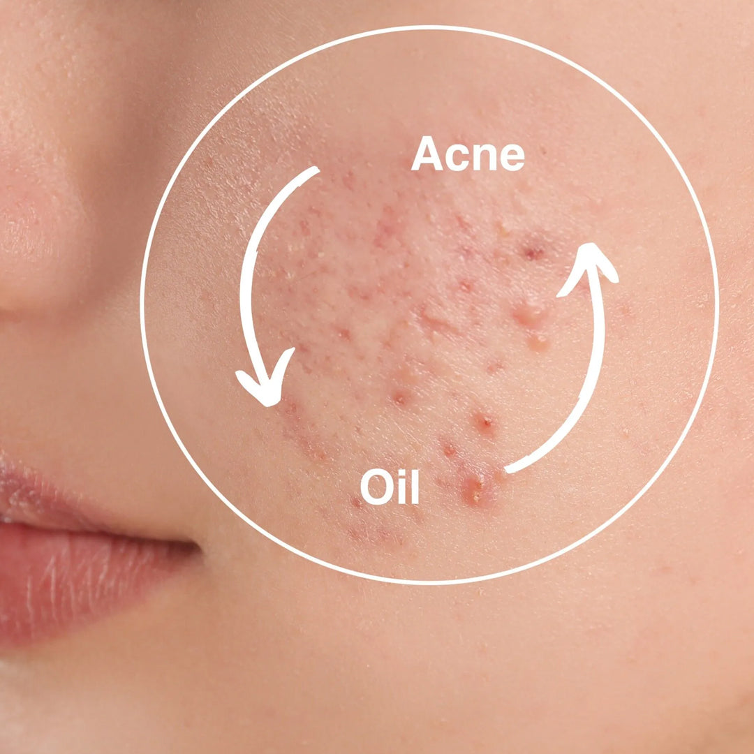 Acne Prone Skin البشرة المعرضة لحب الشباب