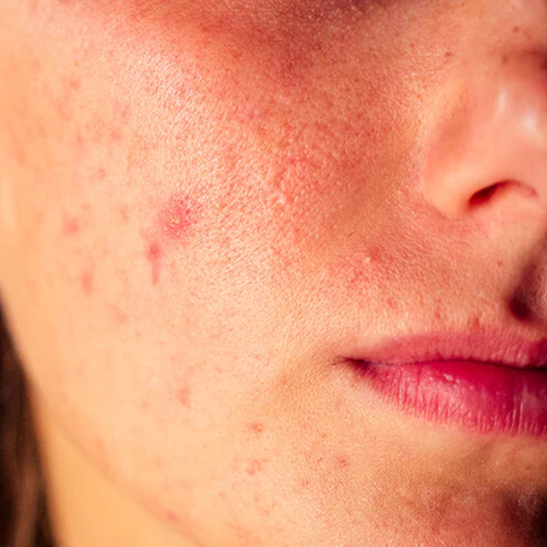 Sensitive Skin البشرة الحساسة