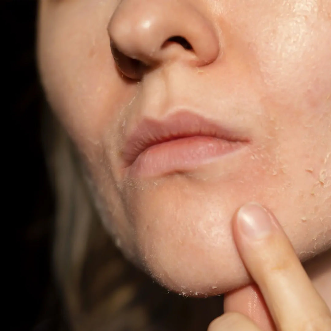 Dry Skin البشرة الجافة